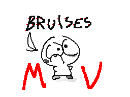 bruises mv